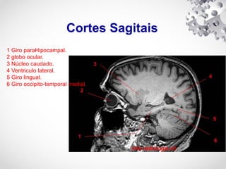 Cortes Sagitais
1 Giro paraHipocampal.
2 globo ocular.
3 Núcleo caudado.
4 Ventriculo lateral.
5 Giro lingual.
6 Giro occipito-temporal medial.
 