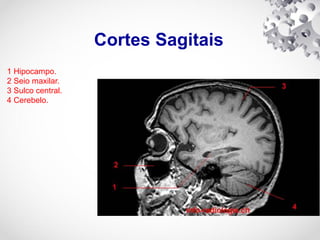 Cortes Sagitais
1 Hipocampo.
2 Seio maxilar.
3 Sulco central.
4 Cerebelo.
 