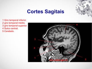 Cortes Sagitais
1 Giro temporal inferior.
2 giro temporal médio.
3 giro temporal superior.
4 Sulco central.
5 Cerebelo.
 