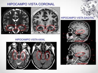 HIPOCAMPO VISTA CORONAL
HIPOCAMPO VISTA SAGITAL
HIPOCAMPO VISTA AXIAL
 