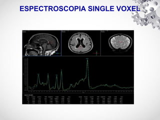 ESPECTROSCOPIA SINGLE VOXEL
 