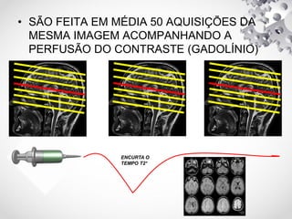 • SÃO FEITA EM MÉDIA 50 AQUISIÇÕES DA
MESMA IMAGEM ACOMPANHANDO A
PERFUSÃO DO CONTRASTE (GADOLÍNIO)
ENCURTA O
TEMPO T2*
 