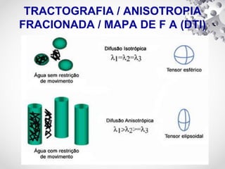 TRACTOGRAFIA / ANISOTROPIA
FRACIONADA / MAPA DE F A (DTI)
 