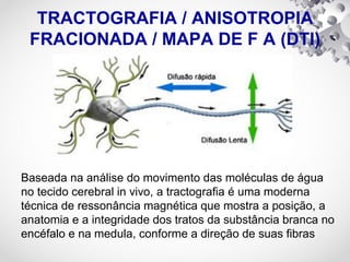 TRACTOGRAFIA / ANISOTROPIA
FRACIONADA / MAPA DE F A (DTI)
Baseada na análise do movimento das moléculas de água
no tecido cerebral in vivo, a tractografia é uma moderna
técnica de ressonância magnética que mostra a posição, a
anatomia e a integridade dos tratos da substância branca no
encéfalo e na medula, conforme a direção de suas fibras
 