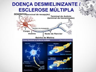 DENDRITOS
DOENÇA DESMIELINIZANTE /
ESCLEROSE MÚLTIPLA
 