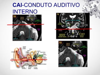 CAI-CONDUTO AUDITIVO
INTERNO
 