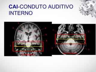 CAI-CONDUTO AUDITIVO
INTERNO
 