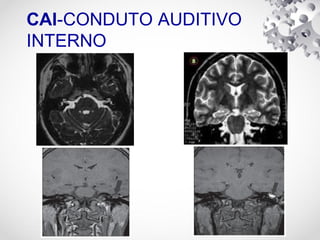 CAI-CONDUTO AUDITIVO
INTERNO
 
