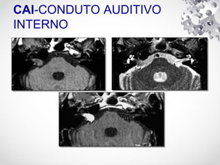 CAI-CONDUTO AUDITIVO
INTERNO
 