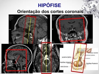 HIPÓFISE
Orientação dos cortes coronais
 