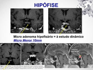 HIPÓFISE
Micro adenoma hipofisário = à estudo dinâmico
Micro Menor 10mm
 