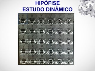 HIPÓFISE
ESTUDO DINÂMICO
 