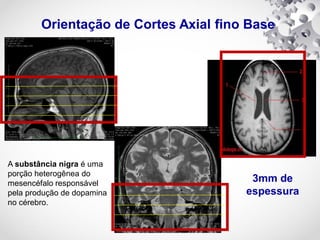 Orientação de Cortes Axial fino Base
3mm de
espessura
A substância nigra é uma
porção heterogênea do
mesencéfalo responsável
pela produção de dopamina
no cérebro.
 