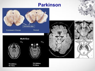 Parkinson
 