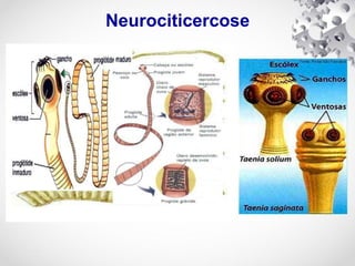 Neurociticercose
 