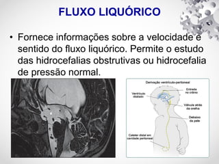 FLUXO LIQUÓRICO
• Fornece informações sobre a velocidade e
sentido do fluxo liquórico. Permite o estudo
das hidrocefalias obstrutivas ou hidrocefalia
de pressão normal.
 