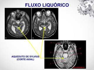 AQUEDUTO DE SYLVIUS
(CORTE AXIAL)
FLUXO LIQUÓRICO
 
