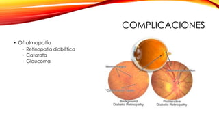 COMPLICACIONES
• Oftalmopatía
• Retinopatía diabética
• Catarata
• Glaucoma
 