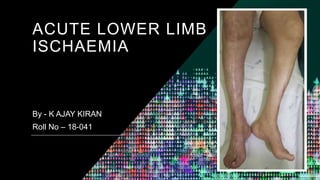 ACUTE LOWER LIMB
ISCHAEMIA
By - K AJAY KIRAN
Roll No – 18-041
 