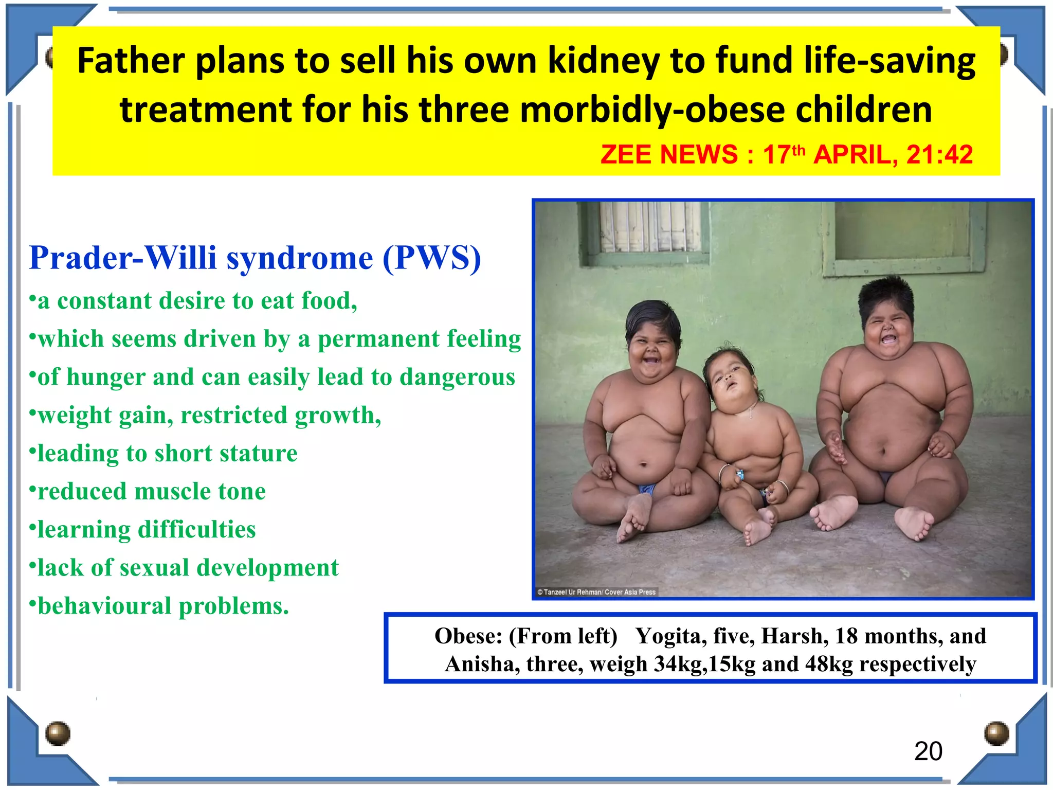 Father plans to sell his own kidney to fund life-saving
treatment for his three morbidly-obese children
Prader-Willi syndrome (PWS)
•a constant desire to eat food,
•which seems driven by a permanent feeling
•of hunger and can easily lead to dangerous
•weight gain, restricted growth,
•leading to short stature
•reduced muscle tone
•learning difficulties
•lack of sexual development
•behavioural problems.
20
ZEE NEWS : 17th
APRIL, 21:42
Obese: (From left) Yogita, five, Harsh, 18 months, and
Anisha, three, weigh 34kg,15kg and 48kg respectively
 