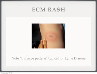 ECM RASH




                   Note “bullseye pattern” typical for Lyme Disease



Thursday, May 17, 12
 