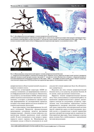 Медведев Ю.А. с соавт.                                                                             Том IV, № 1, 2012




		                a				                                     b					                                    c
Рис. 3. Дизэмбриопластический вариант течения аневризматической болезни
a - гипопластический вариант строения виллизиева круга: узкие сосуды, периметр которых ниже среднего (аневризма перед-
ней соединительной артерии указана стрелкой); b – сосудистая стенка тонкая, эластичная (окраска по Маллори, х 100); c - дис-
плазия соединительной ткани в области бифуркации (метахромазия при окраске толуидиновым синим, х 200)




	                 a				                                b				                                   c
Рис. 4. Инволюционно-гипертонический вариант течения аневризматической болезни
  a - гиперпластический вариант строения виллизиева круга: широкие сосуды, периметр которых выше среднего (аневризма
передней соединительной артерии указана стрелкой); b – сосудистая стенка обычная или утолщена с гипертоническими и/
или инволюционными изменениями (окраска по Маллори, х 100); c - дистрофия соединительной ткани в области мышечно-
эластической гиперплазии (МЭГИ) интимы (метахромазия при окраске толуидиновым синим, х 200)



аневризматиков в области разветвлений сосудов ос-              сосудистой стенки) правильно было бы обозначить
нования головного мозга.                                       как «дивертикул».
   Открытие сегментарной структуры АКБМ по-                       Выделено два типа течения аневризматической
служило основанием для формирования понятия о                  болезни мозга, а по существу две разные болезни. В
его бифуркационной недостаточности. Выяснилось,                их основе, лежит различный этиопатогенез.
что сегменты, составляющие АКБМ, связаны между                    Варианты течения аневризматической болезни
собой соединительнотканными мостиками - сочле-                 могут быть использованы в клинической работе по
нениями, в которых и развиваются предшествую-                  выявлению аневризмоносителей в рамках диспан-
щие формированию Аа дегенеративные процессы,                   серного осмотра по следующему алгоритму: опре-
которые в настоящее время получили название «со-               деление типа телосложения, определение степени
единительнотканная дисплазия».                                 выраженности синдрома дисплазии соединитель-
   Были прослежены этапы формирования Аа в об-                 ной ткани, определение типа артериальной системы
ласти сочленений. Процессом, предшествующим                    (расчёт периметра аорты по рентгенограмме груд-
выпячиванию сочленения, является растяжение                    ной клетки, а, следовательно, и расчёт периметров
(перерастяжение) – distentio; отсюда появилось сло-            крупных артерий виллизиева круга), выяснение не-
восочетание distentio juncturarum circuli arterialis           благоприятных факторов. Лица, попавшие в группы
cerebri. В свете изложенного стоит вопрос о право-             риска должны быть дообследованы с применением
мерности самого термина Аа. Мешковидное вы-                    методов визуализации.
пячивание сосуда в области сочленения (а не всей


Российский нейрохирургический журнал имени профессора А.Л. Поленова                                                   27
 