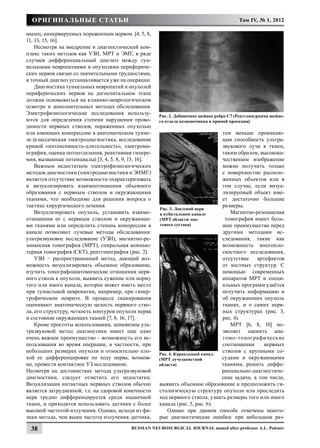 Оригинальные статьи                                                                     Том IV, № 1, 2012

мышц, иннервируемых пораженным нервом. [4, 5, 8,
11, 13, 15, 16].
    Несмотря на внедрение в диагностический ком-
плекс таких методов как УЗИ, МРТ и ЭМГ, в ряде
случаев дифференциальный диагноз между тун-
нельными невропатиями и опухолями перифериче-
ских нервов связан со значительными трудностями,
и точный диагноз устанавливается уже на операции.
    Диагностика туннельных невропатий и опухолей
периферических нервов на догоспитальном этапе
должна основываться на клинико-неврологическом
осмотре и дополнительных методах обследования.
Электрофизиологические исследования использу-         Рис. 2. Добавочное шейное ребро С7 (Рентгенограмма шейно-
ются для определения степени нарушения прово-         го отдела позвоночника в прямой проекции)
димости нервных стволов, пораженных опухолью
или имеющих компрессию в анатомическом тунне-                                   тем меньше проникаю-
ле (классическая электродиагностика, исследование                               щая способность ультра-
кривой «интенсивность-длительность», электроми-                                 звукового луча в ткани,
ография, оценка потоотделения, реактивная гипере-                               таким образом, высокока-
мия, вызванные потенциалы) [3, 4, 5, 8, 9, 15, 16].                             чественное изображение
    Важным недостатком электрофизиологических                                   можно получить только
методов диагностики (электродиагностики и ЭНМГ)                                 с поверхностно располо-
является отсутствие возможности охарактеризовать                                женных объектов или в
и визуализировать взаимоотношения объемного                                     том случае, если визуа-
образования с нервным стволом и окружающими                                     лизируемый объект име-
тканями, что необходимо для решения вопроса о                                   ет достаточно большие
тактике хирургического лечения.                                                 размеры.
                                                      Рис. 3. Локтевой нерв
    Визуализировать опухоль, установить взаимо-       в кубитальном канале         Магнитно-резонансная
отношения ее с нервным стволом и окружающи-           (МРТ области лок-          томография имеет боль-
ми тканями или определить степень компрессии в        тевого сустава)           шие преимущества перед
канале позволяют лучевые методы обследования:                                   другими методами ис-
ультразвуковое исследование (УЗИ), магнитно-ре-                                 следования, такие как
зонансная томография (МРТ), спиральная компью-                                  возможность многопло-
терная томография (СКТ), рентгенография (рис. 2).                               скостного исследования,
    УЗИ − распространенный метод, дающий воз-                                   отсутствие    артефактов
можность визуализировать объемное образование,                                  от костных структур. С
изучить топографоанатомические отношения нерв-                                  помощью современных
ного ствола к опухоли, выявить сужение или норму                                аппаратов МРТ и специ-
того или иного канала, которое может иметь место                                альных программ удаётся
при туннельной невропатии, например, при гипер-                                 получить информацию и
трофическом неврите. В процессе сканирования                                    об окружающих опухоль
оценивают анатомическую целость нервного ство-                                  тканях, и о самих нерв-
ла, его структуру, четкость контуров опухоли нерва                              ных структурах (рис. 3,
и состояние окружающих тканей [7, 8, 16, 17].                                   рис. 4).
    Кроме простоты использования, дешевизны уль-                                   МРТ [6, 8, 10] по-
тразвуковой метод диагностики имеет еще одно                                    зволяет оценить ана-
очень важное преимущество – возможность его ис-                                 томо-топог рафические
пользования во время операции, в частности, при                                 соотношения      нервных
небольших размерах опухоли и относительно пло-                                  стволов с крупными со-
                                                      Рис. 4. Карпальный канал.
хой ее дифференцировке по ходу нерва, возмож-         (МРТ лучезапястной        судами и окружающими
но, провести контактное УЗ исследование.	             области)                  тканями, решить диффе-
Несмотря на достоинствах метода ультразвуковой                                  ренциально-диагностиче-
диагностики, следует отметить его недостатки.                                   ские задачи, в том числе,
Визуализация интактных нервных стволов обычно         выявить объемное образование и предположить ги-
является затрудненной, т.е. на здоровой конечности    стологическую структуру опухоли или проследить
нерв трудно дифференцируется среди мышечной           ход нервного ствола, узнать размеры того или иного
ткани, и приходится использовать датчики с более      канала (рис. 5, рис. 6).
высокой частотой излучения. Однако, исходя из фи-         Однако при данном способе отмечены некото-
зики метода, чем выше частота излучения датчика,      рые диагностические ошибки: при небольшом раз-

 38                                       Russian Neurosurgical Journal named after professor A.L. Polenov
 