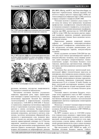 Ростовцев Д.М. с соавт.                                                                  Том IV, № 1, 2012

                                                           RW, ВИЧ, HBsAg, antiHCV, вир.Эпштейна-Барра, на
                                                           бореллиоз отрицательные, выявлен высокий титр
                                                           антител к вирусу простого герпеса (IgG 1:1020), ци-
                                                           томегаловирусную инфекцию (IgG 1:2300), антитела
                                                           к вирусу клещевого энцефалита IGM 1:800.
                                                               Учитывая наличие в анамнезе укуса клеща 5-6
                                                           лет назад (по поводу чего проводилась экстренная
                                                           профилактика специфическим иммуноглобулином
                                                           в отношении клещевого энцефалита, а в последние 2
                                                           года проводилась плановая вакцинация энцефиром),
Рис. 1. МРТ картина диффузных изменений левого полушария
головного мозга без накопления контрастного вещества
                                                           наличие при ИФА диагностике (от 14.05.2010) IgM
                                                           к ВКЭ в титре 1:800, был поставлен диагноз: вирус-
                                                           ный энцефалит, вероятно, клещевой, хроническое
                                                           прогрессирующее течение. Было назначено патоге-
                                                           нетическое лечение.
                                                               Параллельно выявлен вторичный иммуно-
                                                           дефицит с дисбалансом иммунорегуляторных
                                                           субпопуляций Т-лимфоцитов с вовлечением систе-
                                                           мы натуральных киллеров, рекомендовано лече-
                                                           ние (противовирусная терапия, иммуноглобулин
                                                           человека).
                                                               Резкое ухудшение состояния 23.06.2010 (на тре-
Рис. 2. МРТ картина диффузных изменений преимуществен-     тий день после начала противовирусной терапии и
но белого вещества правого и левого полушария головного    иммуноглобулина человека), когда впервые разви-
мозга,с распространением процесса на мозжечек и ножки
мозга                                                      лась серия повторных генерализованных тонико-
                                                           клонических судорог. Состояние больного стало
                                                           тяжелым, проводилась противоотечная, нейропро-
                                                           текторная, противосудорожная (депакин-хроно 900/
                                                           сут) терапия.
                                                               Постепенно был достигнут значительный поло-
                                                           жительный эффект (эпилептические приступы не
                                                           повторялись, восстановилось ясное сознание, умень-
                                                           шилась выраженность правостороннего гемипареза
                                                           (до 4 баллов), регрессировали речевые нарушения.
                                                           Было назначено проведение стероидной терапии
                                                           (дексаметазон 32 мг в течение 14 дней). Однако, на
Рис. 3. МСКТ-ангиография сосудов головного мозга           фоне длительной катетеризации мочевого пузыря
                                                           (с 23.06.2010) развился острый восходящий пиело-
ротоники, витамины, сосудистые, миорелаксанты.             нефрит, вследствие чего состояние больного резко
Улучшения от лечения не наблюдалось.                       ухудшилось.
   Постепенно состояние больного ухудшалось:                   Учитывая тяжесть состояния больного, отсут-
появились нарушения речи, нарос правосторон-               ствие четко очерченного очага по МРТ головного,
ний гемипарез в правых конечностях, и появились            инфекцию МВП, было решено, что риск проведе-
когнитивные нарушения. Больной был повторно                ния биопсии превышает ценность гистологической
госпитализирован в неврологическое отделение,              верификации диагноза и проведение химиотерапии
где находился с 13.05.2010 по 29.05.2010. У больно-        необоснованно.
го выявлялись умеренные когнитивные нарушения                  Поскольку в течение 6 месяцев неврологическая
(отказ от выполнения отдельных команд, снижение            симптоматика прогрессировала, а диагноз оставал-
критики к своему состоянию, быстрая истощае-               ся неясен, больной был направлен в ФГУ РНХИ им.
мость при осмотре, концентрация и переключение             проф. А.Л.Поленова.
внимания затруднены, доступность контакту огра-                На МРТ головного мозга от 12.07.2010 отмеча-
ничена, частичное непонимание обращенной речи,             ется отрицательная динамика с нарастанием пора-
трудности в произношении слов, названии пред-              жения левого полушария головного мозга (лобной,
метов и письма под диктовку, некоторое снижение            височной, теменной долей), мозолистого тела, пара-
памяти); правосторонний гемипарез до 4,5 баллов,           сагиттальных отделов правых лобной и теменной
нарушение мышечно-суставного чувства справа,               долей, распространяется на ствол и левую половину
интенция при выполнении координационных проб,              моста; боковые желудочки деформированы (рис 4).
симптом Кернига положителен. Проводилось по-                   При поступлении в ФГУ РНХИ им. проф. А.Л.
вторное обследование на нейроинфекции: реакции             Поленова состояние больного тяжелое, стабиль-
Российский нейрохирургический журнал имени профессора А.Л. Поленова                                      65
 