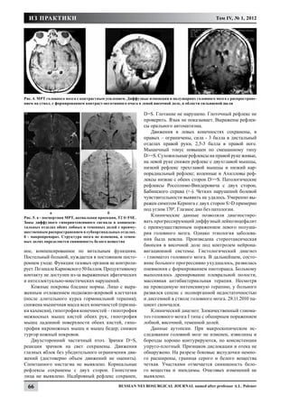 ИЗ ПРАКТИКИ                                                                                   Том IV, № 1, 2012




Рис. 4. МРТ головного мозга с контрастным усилением. Диффузные изменения в полушариях головного мозга с распростране-
нием на ствол, с формированием контраст-негативного очага в левой височной доле, в области сильвиевой щели

                                                              D=S. Глотание не нарушено. Глоточный рефлекс не
                                                              проверить. Язык не показывает. Выражены рефлек-
                                                              сы орального автоматизма.
                                                                  Движения в левых конечностях сохранены, в
                                                              правых – ограничены, сила - 3 балла в дистальный
                                                              отделах правой руки, 2,5-3 балла в правой ноге.
                                                              Мышечный тонус повышен по смешанному типу
                                                              D>=S. Сухожильные рефлексы на правой руке живые,
                                                              на левой руке снижен рефлекс с двухглавой мышцы,
                                                              низкий рефлекс трехглавой мышцы и низкий кар-
                                                              порадиальный рефлекс; коленные и Ахилловы реф-
                                                              лексы низкие с обеих сторон D>=S. Патологические
                                                              рефлексы Россолимо-Виндеровича с двух сторон,
                                                              Бабинского справа (+-). Четких нарушений болевой
                                                              чувствительности выявить не удалось. Умеренно вы-
                                                              ражен симптом Кернига с двух сторон S>D примерно
                                                              под углом 1700. Глазное дно без патологии.
	               а			                       б
Рис. 5. а - посмертная МРТ, аксиальная проекция, Т2 fr FSE.
                                                                  Клинические данные позволяли диагностиро-
Зоны диффузного гиперинтенсивного сигнала в конвекси-         вать прогрессирующий диффузный лейкоэнцефалит
тальных отделах обеих лобных и теменных долей с преиму-       с преимущественным поражением левого полуша-
щественным распространением в субкортикальных отделах.        рия головного мозга. Однако этиология заболева-
б - макропрепарат. Структура мозга не изменена, в темен-
ных долях определяется синюшность белого вещества
                                                              ния была неясна. Произведена стереотаксическая
                                                              биопсия в височной доле под контролем нейрона-
ное, компенсированное по витальным функциям.                  вигационной системы. Гистологический диагноз
Постельный больной, нуждается в постоянном посто-             - глиоматоз головного мозга. В дальнейшем, состо-
роннем уходе. Функции тазовых органов не контроли-            яние больного прогрессивно ухудшалось, развилась
рует. По шкале Карновского 50 баллов. Продуктивному           пневмония с формированием пиоторакса. Больному
контакту не доступен из-за выраженных афатических             выполнялось дренирование плевральной полости,
и интеллектуально-мнестических нарушений.                     массивная антибактериальная терапия. Несмотря
   Кожные покровы бледнее нормы. Лицо с выра-                 на проводимую интенсивную терапию, у больного
женным отложением подкожно-жировой клетчатки                  развился сепсис с полиорганной недостаточностью
(после длительного курса гормональной терапии);               и дисгемией в стволе головного мозга. 28.11.2010 па-
снижена мышечная масса всех конечностей (призна-              циент скончался.
ки кахексии), гипотрофия конечностей – гипотрофия                 Клинический диагноз: Злокачественный глиома-
межкосных мышц кистей обеих рук, гипотрофия                   тоз головного мозга I типа с обширным поражением
мышц ладонной поверхности обеих кистей, гипо-                 лобной, височной, теменной долей.
трофия икроножных мышц и мышц бедер; снижен                       Данные аутопсии. При макроскопическом ис-
тургор кожный покровов.                                       следовании головной мозг не изменен, извилины и
   Двухсторонний частичный птоз. Зрачки D=S,                  борозды хорошо контурируются, по консистенции
реакции зрачков на свет сохранены. Движения                   упруго-плотный. Признаков дислокации и отека не
глазных яблок без убедительного ограничения дви-              обнаружено. На разрезе боковые желудочки немно-
жений (достоверно объем движений не оценить).                 го расширены, граница серого и белого вещества
Спонтанного нистагма не выявлено. Корнеальные                 четкая. Участками отмечается синюшность бело-
рефлексы сохранены с двух сторон. Гипестезии                  го вещества и эпендимы. Очаговых изменений не
лица не выявлено. Надбровный рефлекс сохранен,                выявлено.

  66                                             Russian Neurosurgical Journal named after professor A.L. Polenov
 