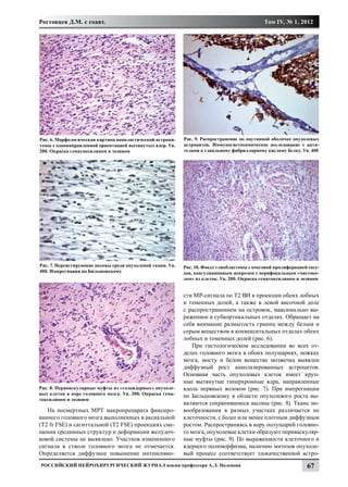 Ростовцев Д.М. с соавт.                                                                       Том IV, № 1, 2012




Рис. 6. Морфологическая картина анапластической астроци-    Рис. 9. Распространение по паутинной оболочке опухолевых
томы с однонаправленной ориентацией вытянутых ядер. Ув.     астроцитов. Иммуногистохимическое исследование с анти-
200. Окраска гематоксилином и эозином                       телами к глиальному фибриллярному кислому белку. Ув. 400




Рис. 7. Персистирующие аксоны среди опухолевой ткани. Ув.   Рис. 10. Фокус глиобластомы с очаговой пролиферацией сосу-
400. Импрегнация по Бильшовскому                            дов, коагуляционным некрозом с перифокальным «частоко-
                                                            лом» из клеток. Ув. 200. Окраска гематоксилином и эозином


                                                            сти МР-сигнала по Т2 ВИ в проекции обеих лобных
                                                            и теменных долей, а также в левой височной доле
                                                            с распространением на островок, максимально вы-
                                                            раженное в субкортикальных отделах. Обращает на
                                                            себя внимание размытость границ между белым и
                                                            серым веществом в конвекситальных отделах обеих
                                                            лобных и теменных долей (рис. 6).
                                                                При гистологическом исследовании во всех от-
                                                            делах головного мозга в обоих полушариях, ножках
                                                            мозга, мосту и белом веществе мозжечка выявлен
                                                            диффузный рост анаплазированных астроцитов.
                                                            Основная часть опухолевых клеток имеет круп-
                                                            ные вытянутые гиперхромные ядра, направленные
Рис. 8. Периваскулярные муфты из «голоядерных» опухоле-     вдоль нервных волокон (рис. 7). При импрегнации
вых клеток в коре головного мозга. Ув. 200. Окраска гема-
                                                            по Бильшовскому в области опухолевого роста вы-
токсилином и эозином
                                                            являются сохранившиеся аксоны (рис. 8). Ткань но-
   На посмертных МРТ макропрепарата фиксиро-                вообразования в разных участках различается по
ванного головного мозга выполненных в аксиальной            клеточности, с более или менее плотным диффузным
(Т2 fr FSE) и сагиттальной (Т2 FSE) проекциях сме-          ростом. Распространяясь в кору полушарий головно-
щения срединных структур и деформации желудоч-              го мозга, опухолевые клетки образуют периваскуляр-
ковой системы не выявлено. Участков измененного             ные муфты (рис. 9). По выраженности клеточного и
сигнала в стволе головного мозга не отмечается.             ядерного полиморфизма, наличию митозов опухоле-
Определяется диффузное повышение интенсивно-                вый процесс соответствует злокачественной астро-
Российский нейрохирургический журнал имени профессора А.Л. Поленова                                             67
 