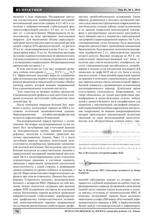ИЗ ПРАКТИКИ                                                                                     Том IV, № 1, 2012

введения в ходе операции). Поддержание анесте-                 лактику тромбоэмболических осложнений. Таким
зии осуществлялось комбинированной методикой:                  образом, развившиеся у больного осложнения яви-
ингаляционный анестетик севоран 4-2,5 об.% в со-               лись следствием посттракционных повреждений ме-
четании с нейровегетативной стабилизацией фен-                 дио-базальных отделов лобных долей (клинически
танил-клофелиновой смесью ( 1,5 мкг/ кг∙ ч и 0,45              и по данным спиральной компьютерной томогра-
мкг/ кг∙ ч соответственно). Миорелаксанты не ис-               фии) и рестриктивных дыхательных расстройств,
пользовались на всем протяжении многочасовой                   часто имевших место у пациентов с миотонической
операции. Для восполнения объема циркулирую-                   дистрофией в периоперационном периоде. На 7-е по-
щей крови использовались кристаллоидный раствор                слеоперационные сутки больному была выполнена
натрия хлорида 0,9%-физиологический - из расчета               операция трахеостомия с проведением санационной
25 мл/ кг, свежезамороженная плазма 15 мл/ кг ; эри-           бронхоскопии, была выявлена эндоскопическая кар-
троцитарная взвесь 15 мл /кг. Коллоидные растворы              тина эндобронхита 2 ст., присоединились явления
на основе гидроксиэтилкрахмала не предполагались               острого цистита. Высокая лихорадка до 39,1 С, по-
для использования из-за опасности развития в связи             ложительный прокальцитониновый тест выше 2,
с их введением гиперкалиемии. Интраоперационная                наличие двух очагов воспаления ( эндобронхит, ци-
кровопотеря составила 1 л.                                     стит), гемодинамическая нестабильность, потребо-
    В ходе анестезии на 7-ом часу операции разви-              вавшая в течение суток инотропной поддержки (АД
лась стойкая гипотермия ( t ректальная 35,10 С; tпериф 34,20   снижалось до цифр 60/35 мм рт ст), были в пользу
С). Эффективными оказались меры по согреванию                  диагноза сепсис. Смена антибактериальной терапии
кристаллоидных растворов и плазмы перед внутри-                на меронем в сочетании с ванкомицином, интенсив-
венным введением в специальной установке «Barkey               ная терапия сепсиса имели положительный эффект,
warming center», которой оснащен операционный                  больной справился с развившимися осложнениями
блок и реанимационное отделение института.                     послеоперационного периода. Длительное время
    Этап гемостаза не вызывал особых трудностей.               отсутствовала спонтанность, бодрствование, что
Гемодинамический профиль в ходе анестезии и опе-               также объяснялось не только расстройствами кро-
рации отличался достаточной стабильностью пока-                вообращения в медио-базальных отделах лобных
зателей (рис. 4).                                              долей у данного больного, но и специфичными для
    После окончания операции больной был пере-                 пациентов с миотонической дистрофией централь-
веден в палату интенсивной терапии на ИВЛ в со-                ной гиперсомнией (подобная нарколепсии централь-
стоянии остаточной медикаментозной седации.                    ная гиперсомния, по мнению североамериканских
Периоперационная        антибиотикопрофилактика                авторов практических рекомендаций) вследствие
включала цефалоспорины II поколения.                           связанной со сном вентиляционной недостаточ-
    Послеоперационный период протекал с ослож-                 ностью или обструктивным сонным апноэ,- про-
нениями. На вторые послеоперационные сутки па-
циент был экстубирован при отчетливой реакции
на эндотрахеальную трубку, хорошем кашлевом
рефлексе, находился в сознании, правильно вы-
полнял предложенные задания. Через 12 ч после
экстубации наросли признаки дыхательной недо-
статочности, потребовалось проведение неинвазив-
ной легочной вентиляции. Последующие трое суток
больной находился на самостоятельном дыхании с
периодической поддержкой неинвазивной вентиля-                 Рис. 5. Игольчатая электромиография. ПДЕ
цией. На 6-е послеоперационные сутки отмечалась
отрицательная динамика в состоянии пациента,
связанная с нарастанием проявлений дыхательной
недостаточности, с одной стороны, и депривацией
уровня сознания до уровня глубокого оглушения, с               Рис. 6. Игольчатая ЭМГ. Спонтанная активность m. biceps
другой. Нарастания очагового неврологического де-              brachii sin
фицита при этом не отмечалось. Пациент был инту-
бирован. Сохранялось тахипноэ, десинхронизация                 явлений заболевания, каждое из которых может
больного с аппаратом ИВЛ. Обращали на себя вни-                привести к глубокой депривации на любом этапе пе-
мание низкие показатели сатурации при высоких                  риоперационного периода. Ближайшей клинической
цифрах FiO2 (содержания кислорода во вдыхаемой                 задачей после санации очагов воспаления и сепси-
смеси). Интенсивная терапия включала проведение                са явилось отлучение от вспомогательной ИВЛ. В
нейровегетативной стабилизации, церебропротек-                 комплекс интенсивной терапии были включены
ции, профилактику гнойно-септических осложне-                  амантадина сульфат (ПК-мерц), облегчающий дофа-
ний, симптоматическую терапию, направленную                    минергическую передачу в ЦНС и нормализующие
на улучшение реологических свойств крови, профи-               баланс между глютаматергической и дофаминерги-

  74                                              Russian Neurosurgical Journal named after professor A.L. Polenov
 