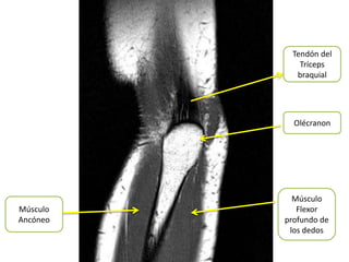 Tendón del
             Tríceps
            braquial




            Olécranon




            Músculo
Músculo      Flexor
Ancóneo   profundo de
           los dedos
 