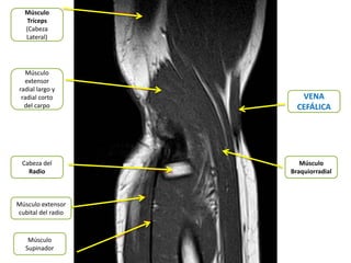 Músculo
  Tríceps
  (Cabeza
  Lateral)




   Músculo
  extensor
radial largo y
 radial corto          VENA
  del carpo           CEFÁLICA




 Cabeza del            Músculo
   Radio            Braquiorradial



Músculo extensor
cubital del radio



    Músculo
   Supinador
 