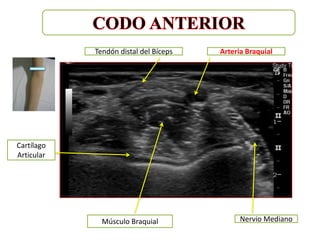 Tendón distal del Bíceps   Arteria Braquial




Cartílago
Articular




              Músculo Braquial               Nervio Mediano
 