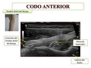 Tendón distal del Bíceps




Inserción del
Tendón distal                Músculo
  del Bíceps                Supinador




                            Cabeza del
                              Radio
 