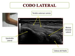 Tendón extensor común




                                                   Receso
                                                   Sinovial
                                                   Lateral


Epicóndilo
 Lateral




                                     Cabeza del Radio
 