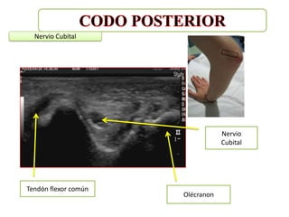 Nervio Cubital




                                  Nervio
                                  Cubital




Tendón flexor común
                      Olécranon
 