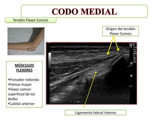 Tendón Flexor Común

                                          Origen del tendón
                                            flexor Común




    MÚSCULOS
    FLEXORES

•Pronador redondo
•Palmar mayor
•Flexor común
superficial de los
dedos
•Cubital anterior

                        Ligamento lateral interno
 