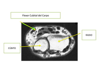 Flexor Cubital del Carpo




                                    RADIO




CÚBITO
 