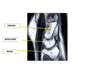 GRANDE




SEMILUNAR




 RADIO
 