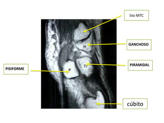5to MTC




            GANCHOSO




             PIRAMIDAL
PISIFORME




            cúbito
 