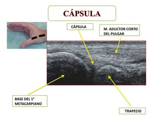 CÁPSULA
                         M. ADUCTOR CORTO
                         DEL PULGAR




BASE DEL 1°
METACARPIANO
                                  TRAPECIO
 