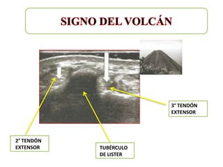 3° TENDÓN
                        EXTENSOR




2° TENDÓN
EXTENSOR    TUBÉRCULO
            DE LISTER
 