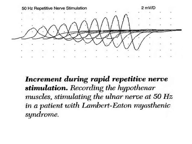 Rns Test Rapid Nerve Stimulation study Part 1 | PPT