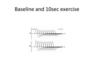 Rns Test REPETITIVE NERVE STIMULATION (RNS) | PPT