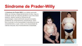 Síndrome de Prader-Willy 
A Síndrome de Prader-Willi é um defeito que pode 
afetar as crianças independentemente do sexo, raça ou 
condição social, de natureza genética e que inclui baixa 
estatura, retardo mental ou transtornos de 
aprendizagem, desenvolvimento sexual incompleto, 
problemas de comportamento característicos, baixo 
tono muscular e uma necessidade involuntária de comer 
constantemente, a qual, unida a uma necessidade de 
calorias reduzida, leva invariavelmente à obesidade. 
 