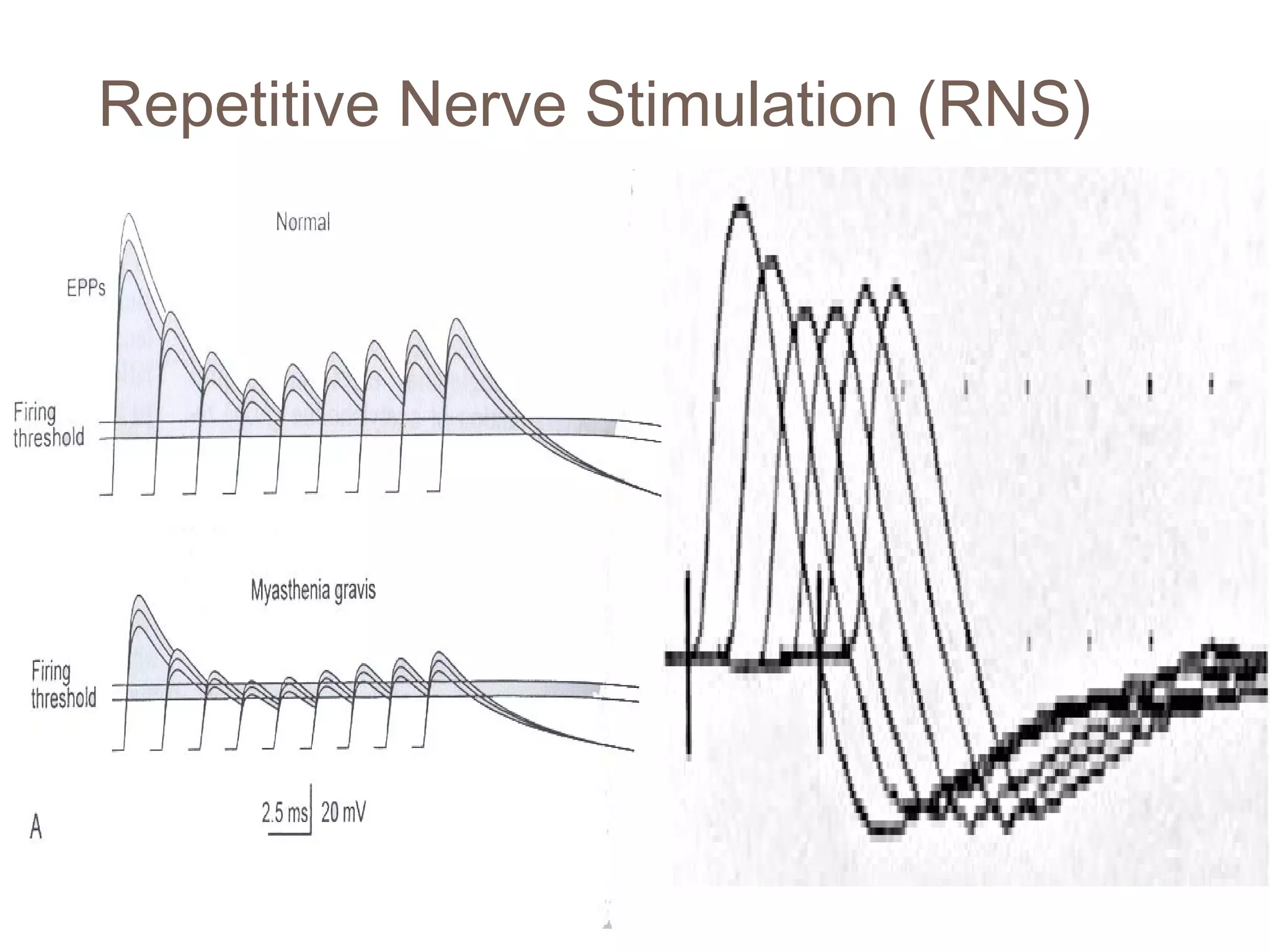 Repetitive Nerve Stimulation (RNS)
 