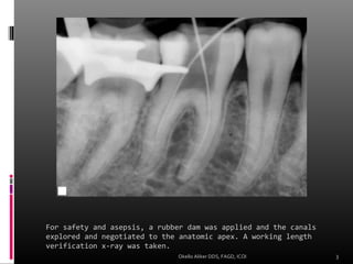Road Map to a Successful Root Canal. | PPT