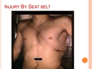 INJURY BY SEAT BELT

 