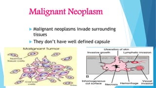 Malignant Neoplasm
 Malignant neoplasms invade surrounding
tissues
 They don’t have well defined capsule
 